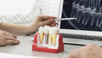 What to Know Before Your First Implant Consultation