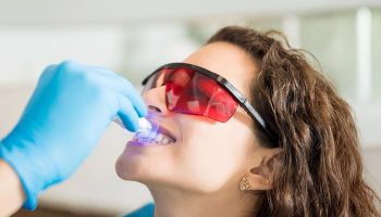 How Teeth Whitening Works—and What Results to Expect