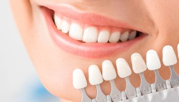 What Are Dental Veneers? A Complete Guide for First-Timers