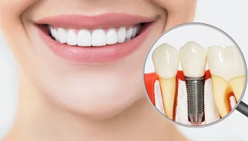 The Step-by-Step Dental Implant Procedure Explained