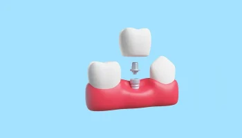 Can Dental Implants Help Prevent Bone Loss After Tooth Loss?
