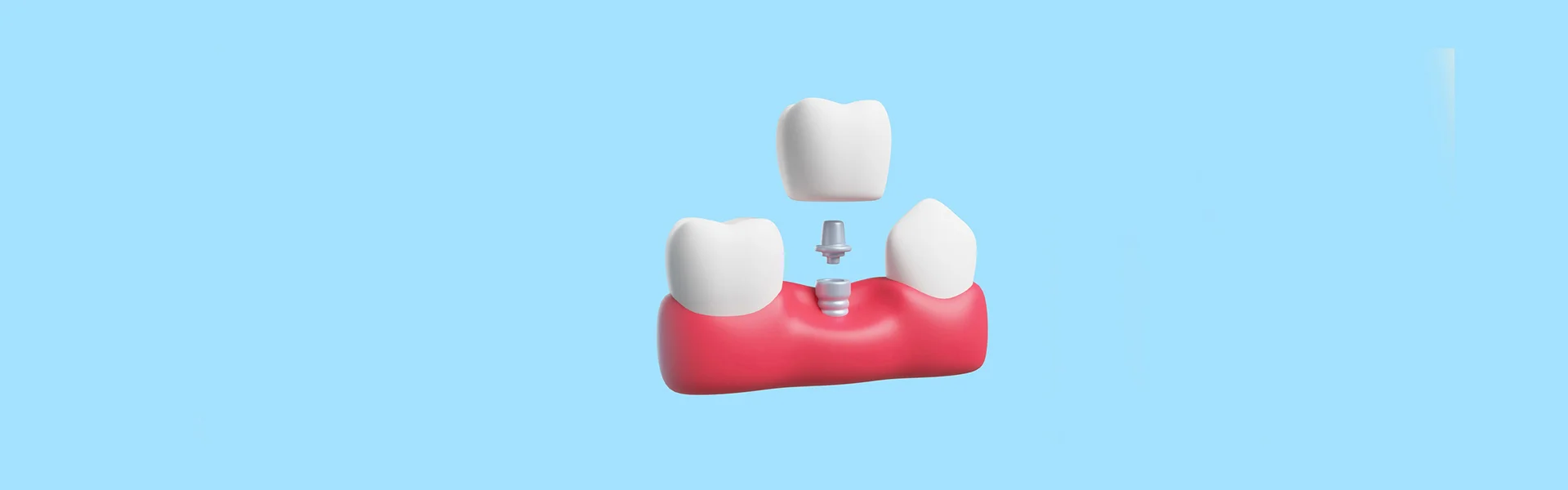 Can-Dental-Implants-Help-Prevent-Bone-Loss-After-Tooth-Loss